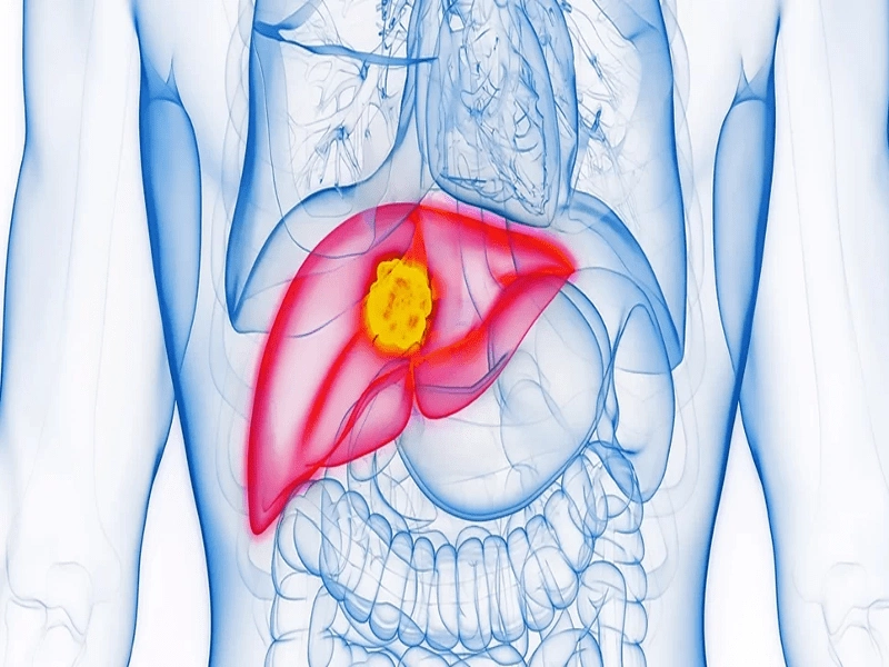 جراحی کبد دکتر یحیی ضرغامی