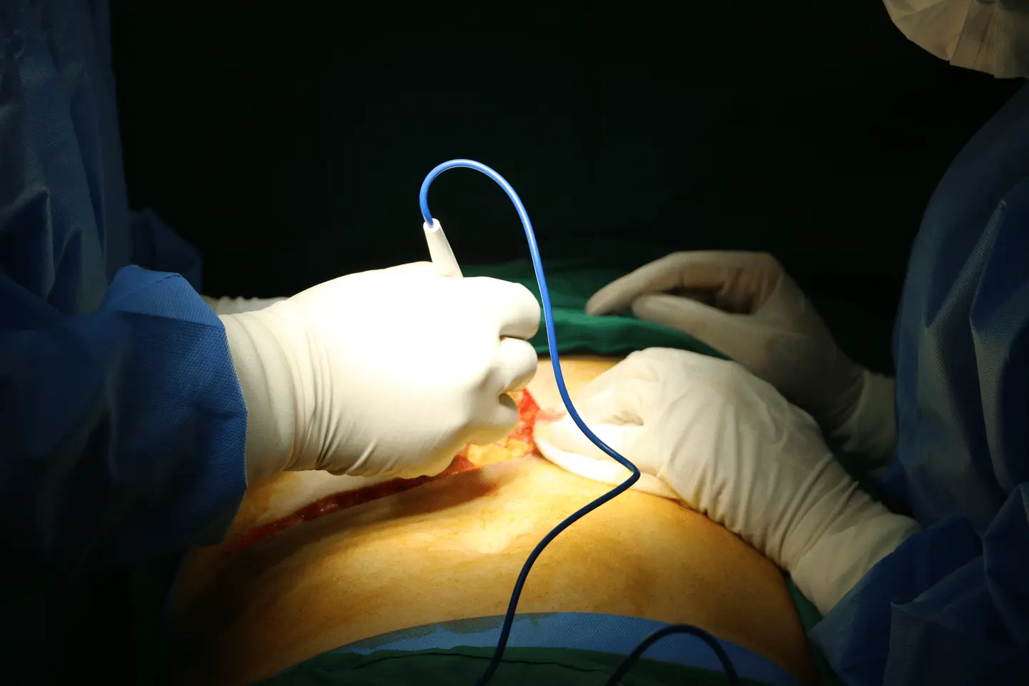 جراحی ای آر سی پی