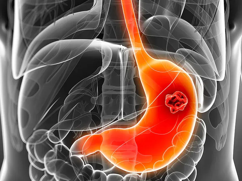 سرطان معده