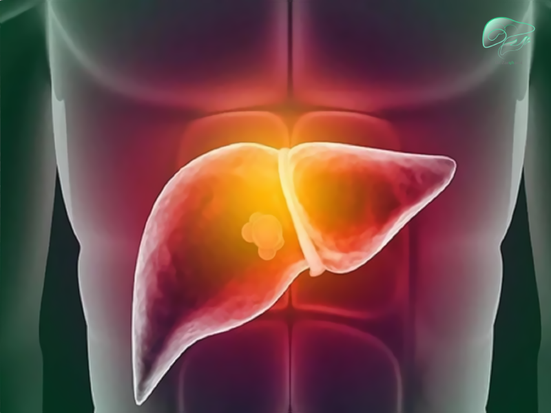 همانژیوم کبد