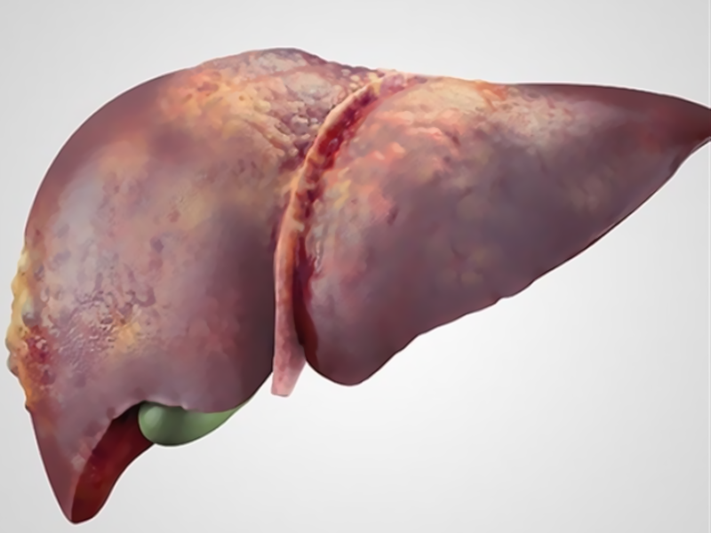 cirrhosis
