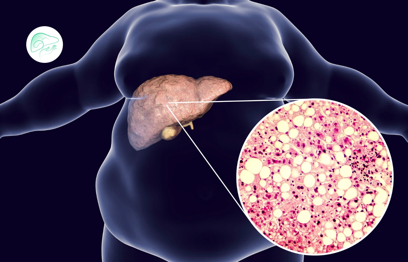 انواع گریدهای کبد چرب