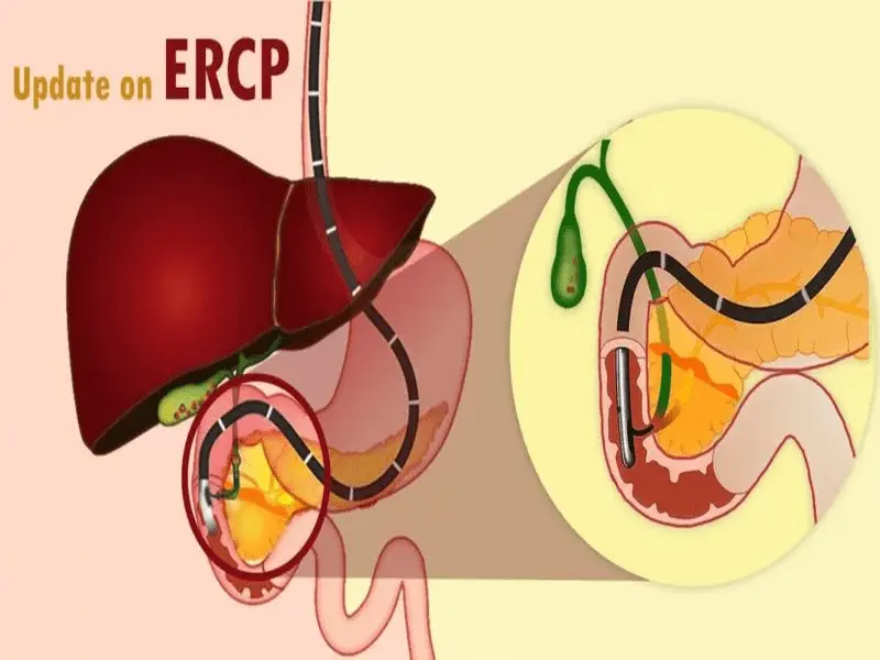تجهیزات ERCP