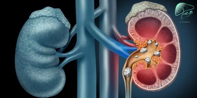 روش های پیشگیری از سنگ کلیه