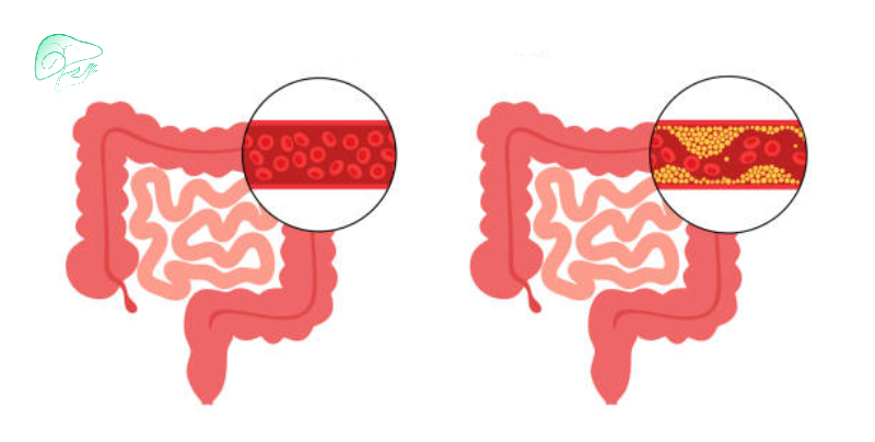 ایسکمی مزانتر روده چیست؟ علل، علائم و درمان