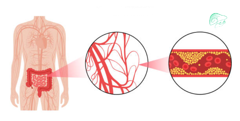 تشخیص بیماری ایسکمی مزانتر