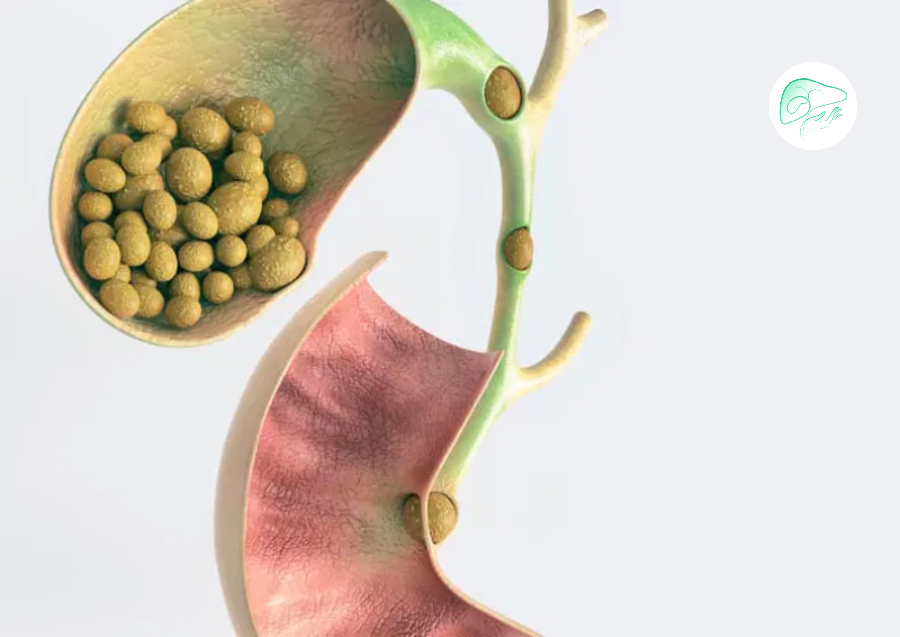 علائم سنگ کیسه صفرا در زنان و مردان