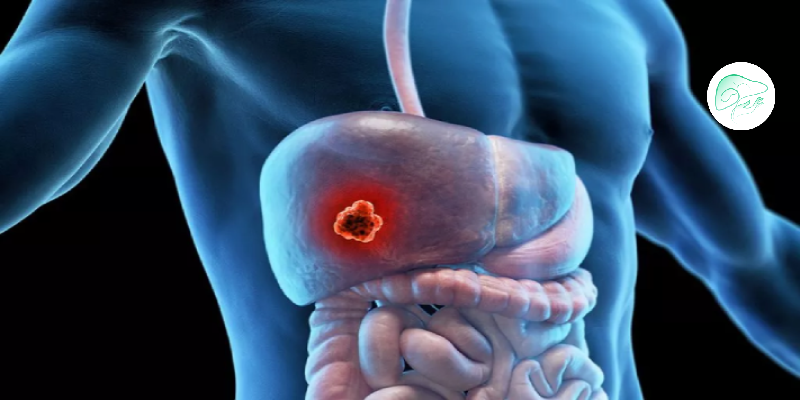 تومور خوش‌خیم کبد؛ انواع، علل و درمان آنها