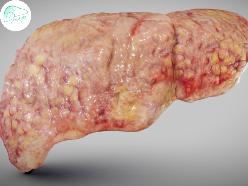 بیماری کبد چرب