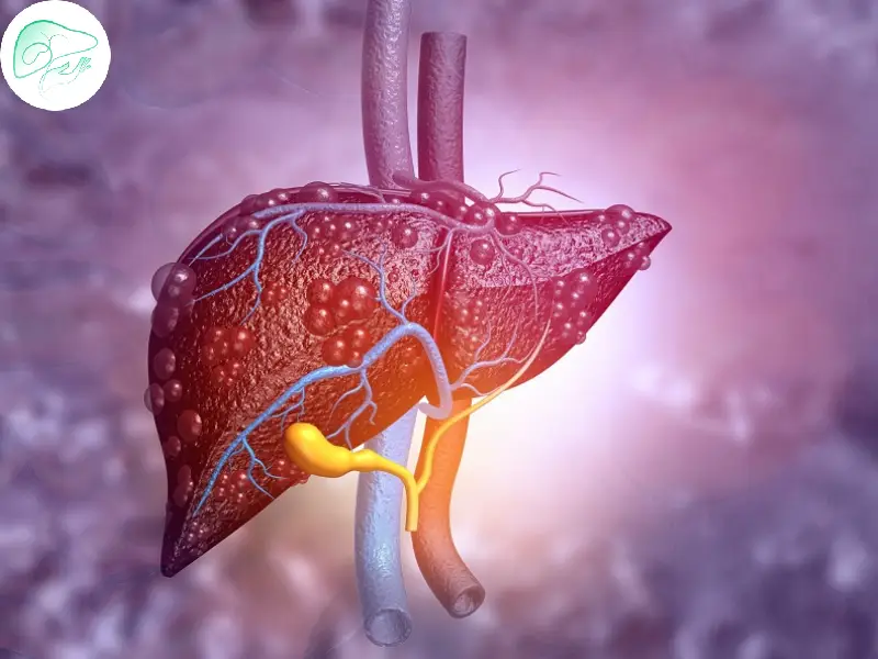 فیبروز کبدی