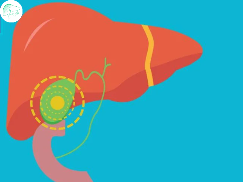 پولیپ کیسه صفرا