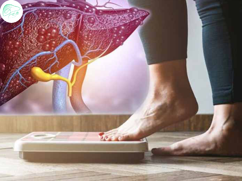 ارتباط اضافه وزن و کبد