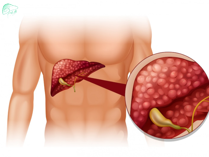 پولیپ کیسه صفرا