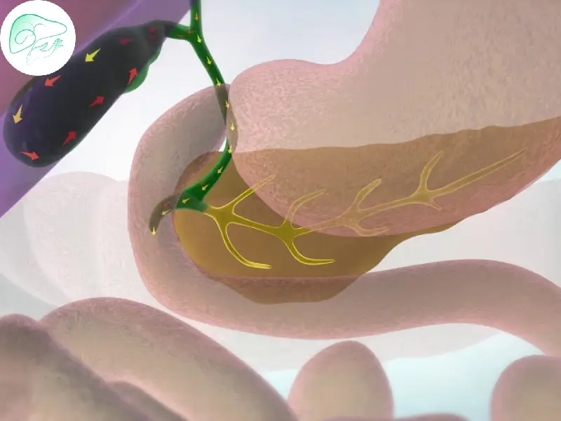 رژیم غذایی و پیشگیری از تشکیل سنگ های صفراوی