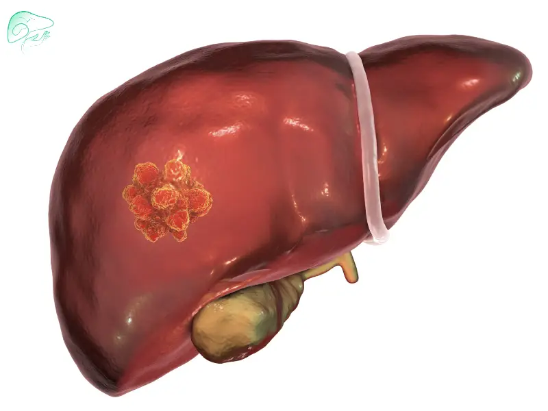 علائم همانژیوم کبدی