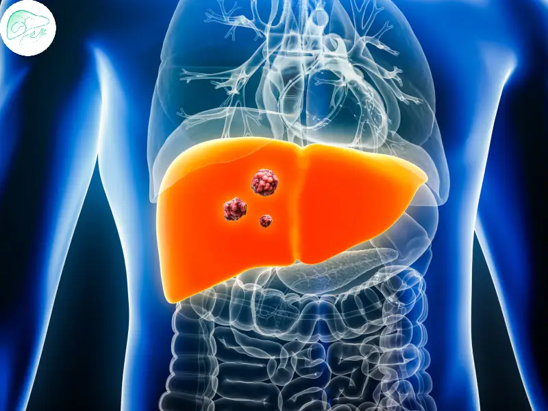 علت و عوامل خطر همانژیوم کبدی