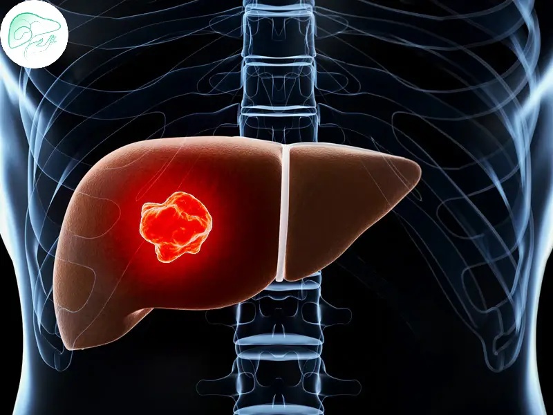 همانژیوم کبدی چیست؟