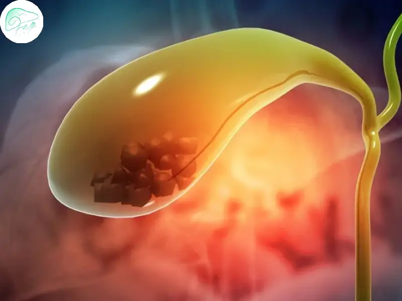 تغذیه مناسب برای پیشگیری از بازگشت سنگ صفرا