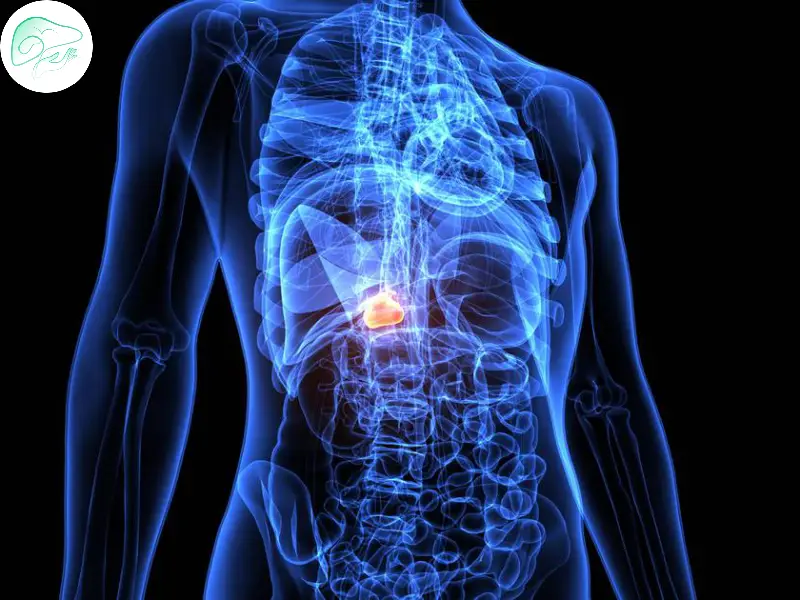 روش‌های پیشگیری از بازگشت سنگ صفرا پس از جراحی